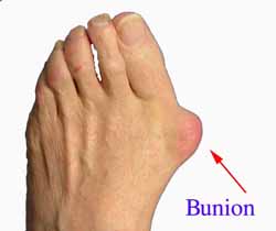 Bunions Callous