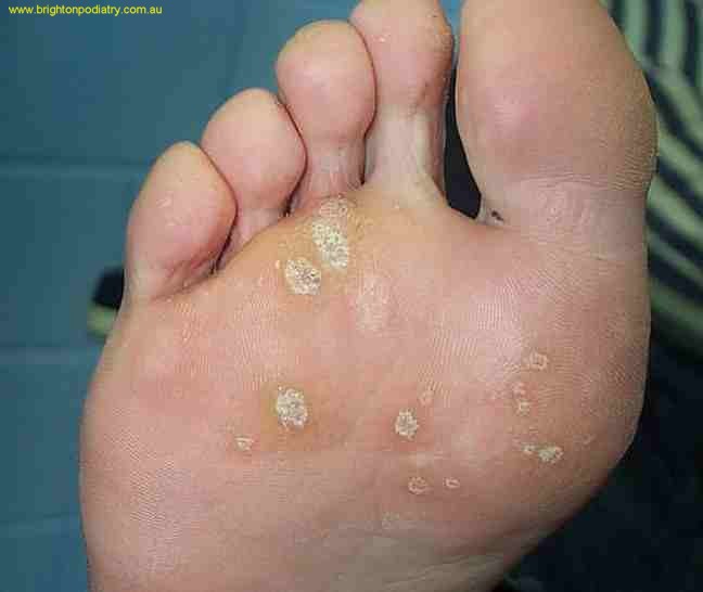 warts plantar