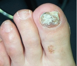 infected toenail