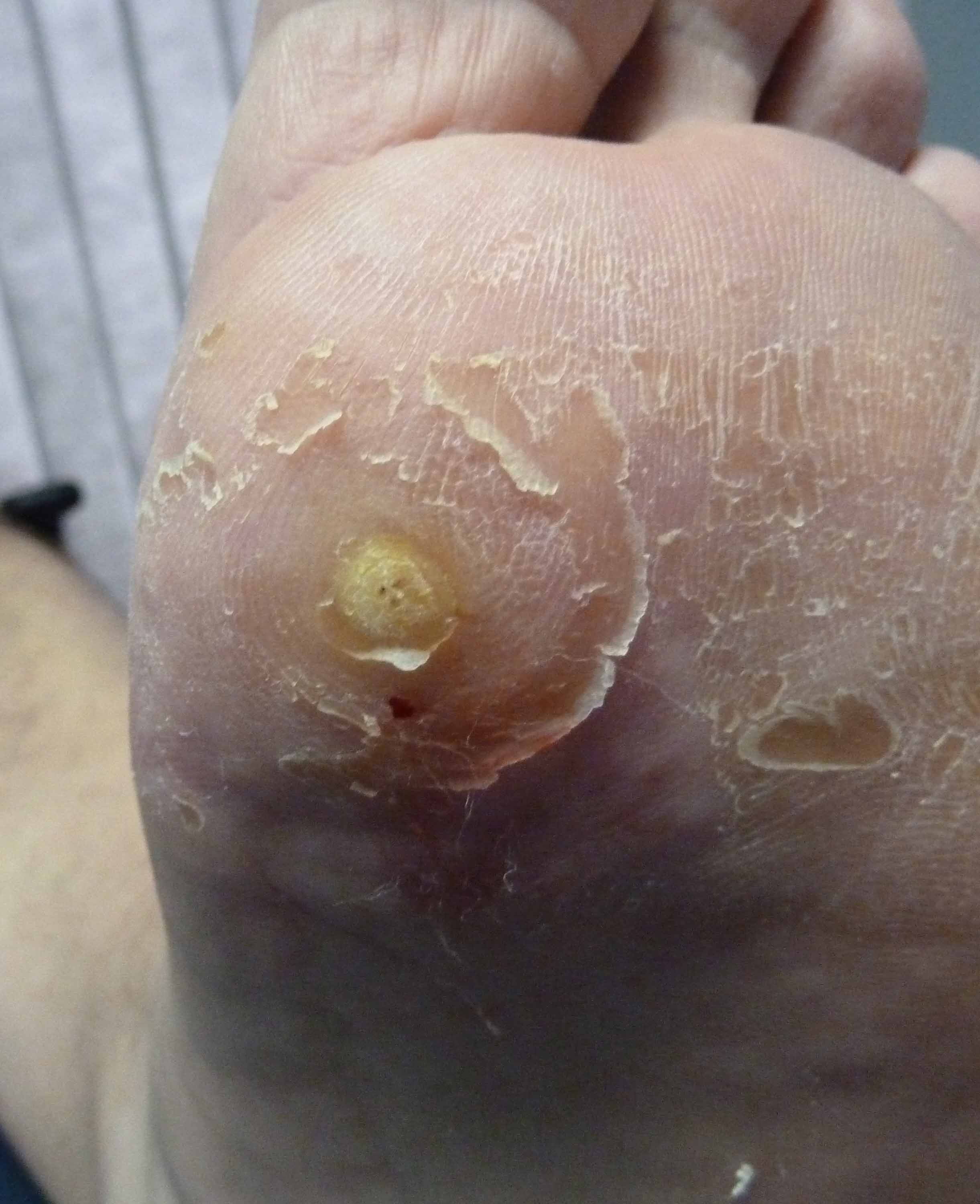 Wart treatment melbourne - RELATED ARTICLES