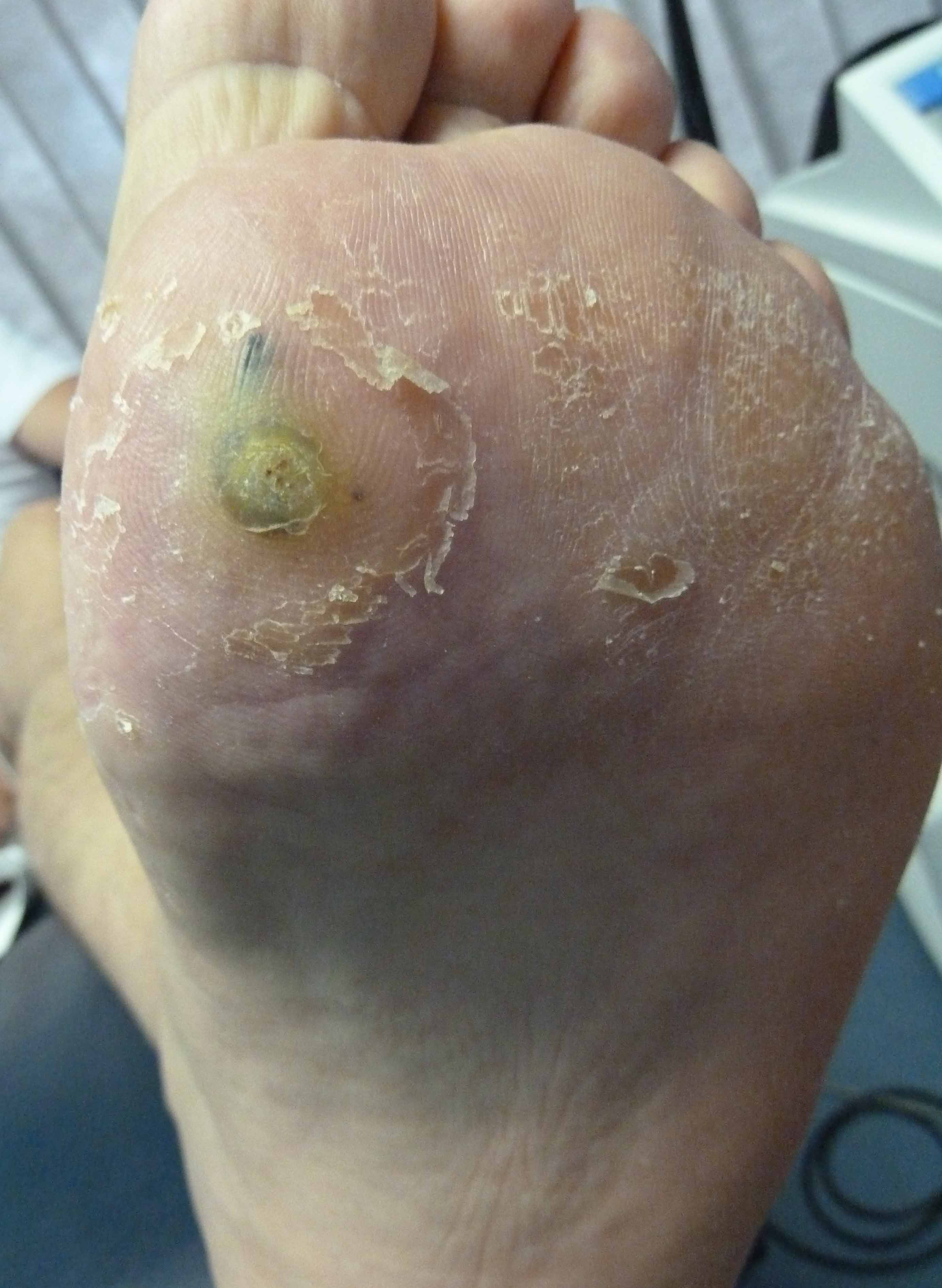 warts treatment plantar wart treatment brightonpodiatry au warts treatment plantar wart treatment brightonpodiatry au