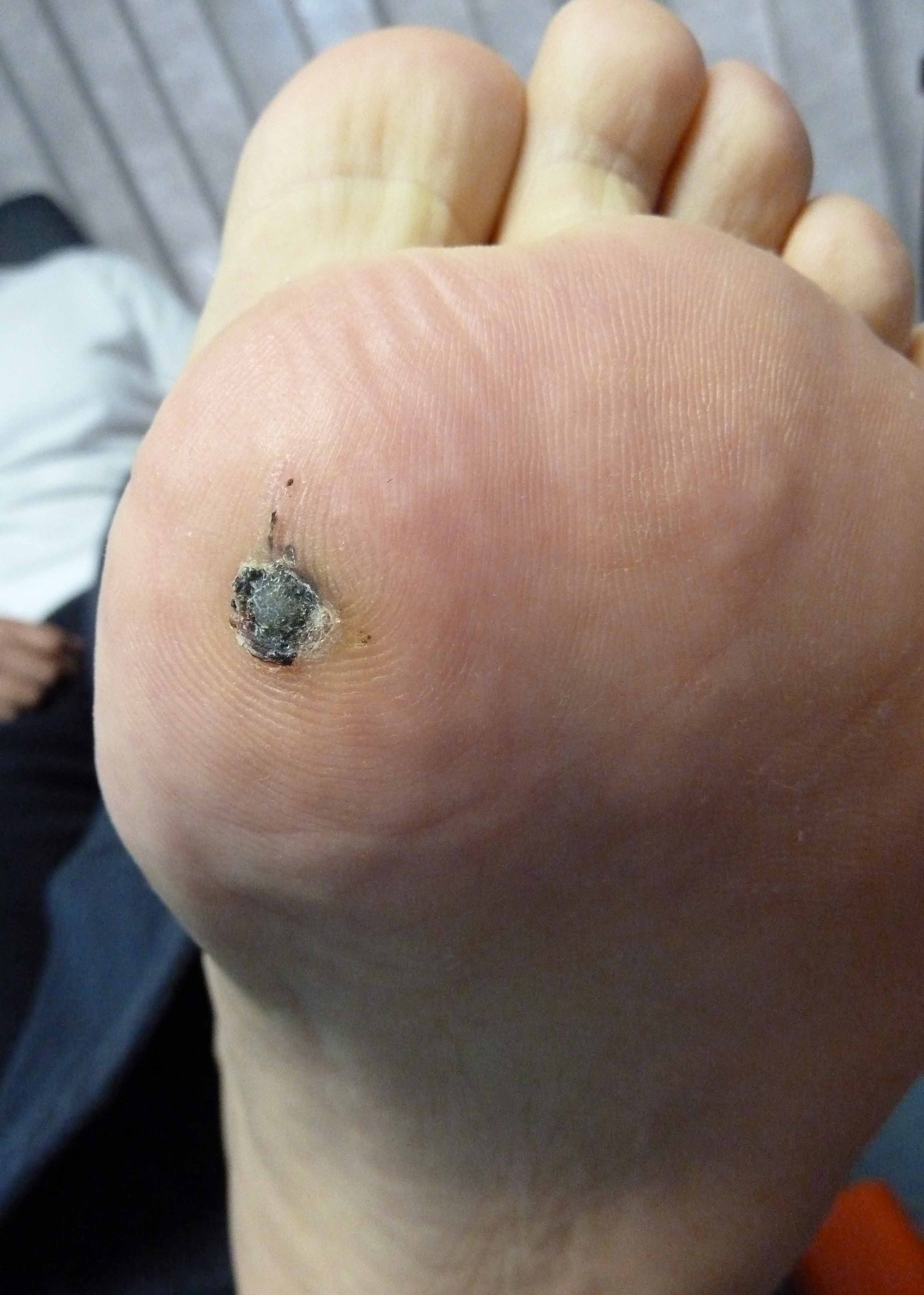 Plantar wart - Wikipedia