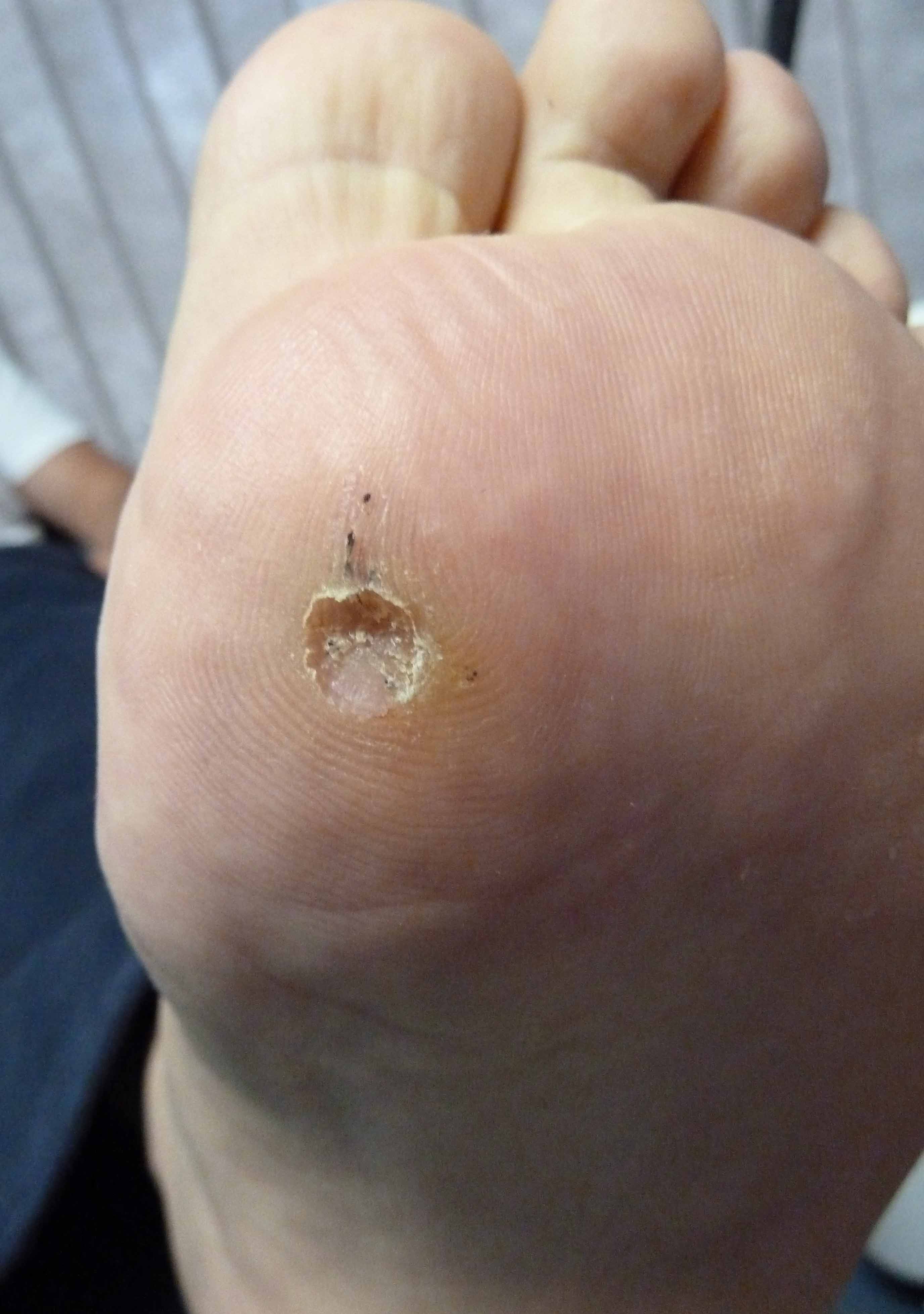 Plantar wart - Wikipedia