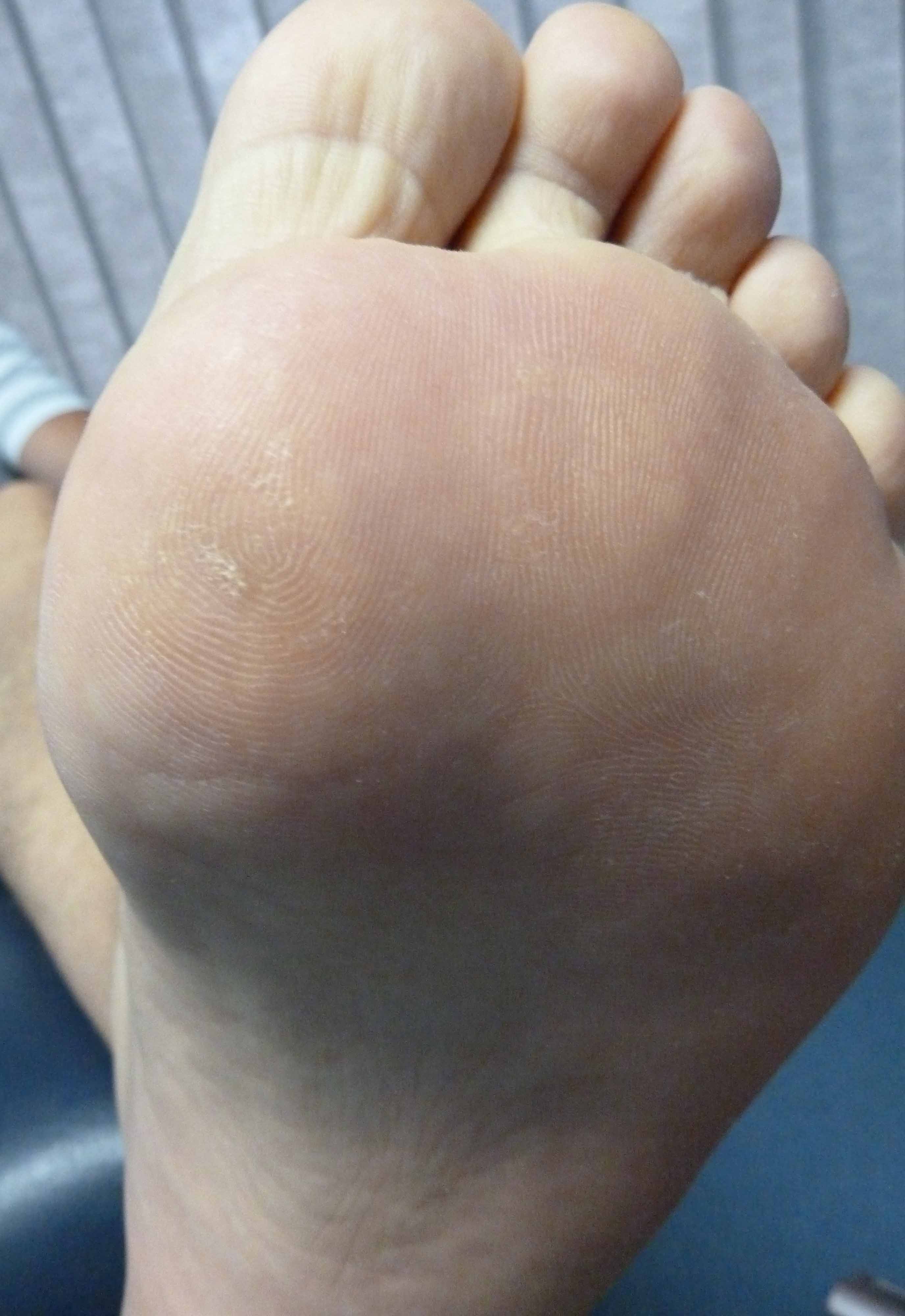 Plantar Wart Treatment