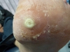 plantar-wart-treatment-1