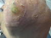 plantar-wart-treatment-3