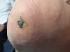 plantar-wart-treatment-4