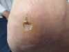 plantar-wart-treatment-5