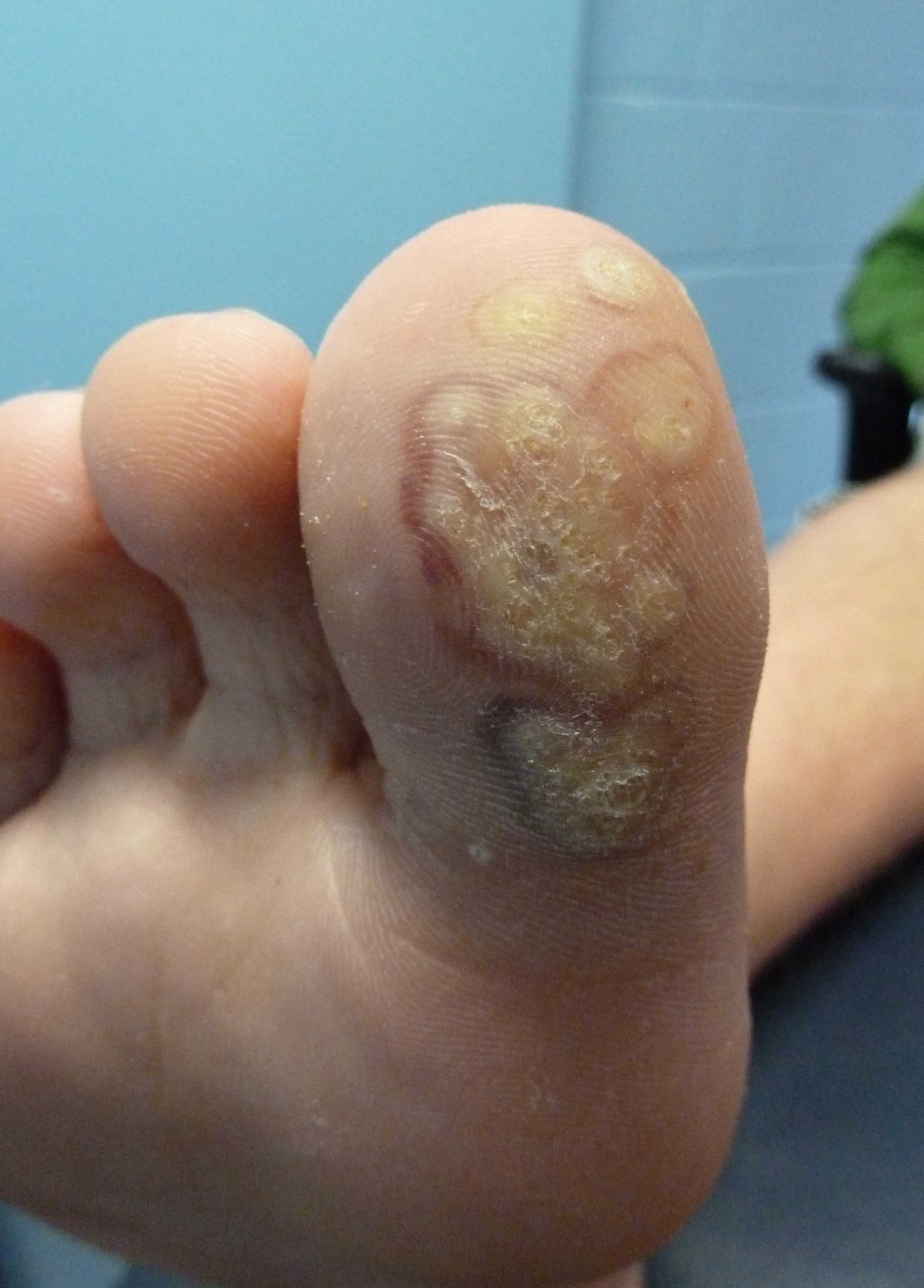 plantar wart pics