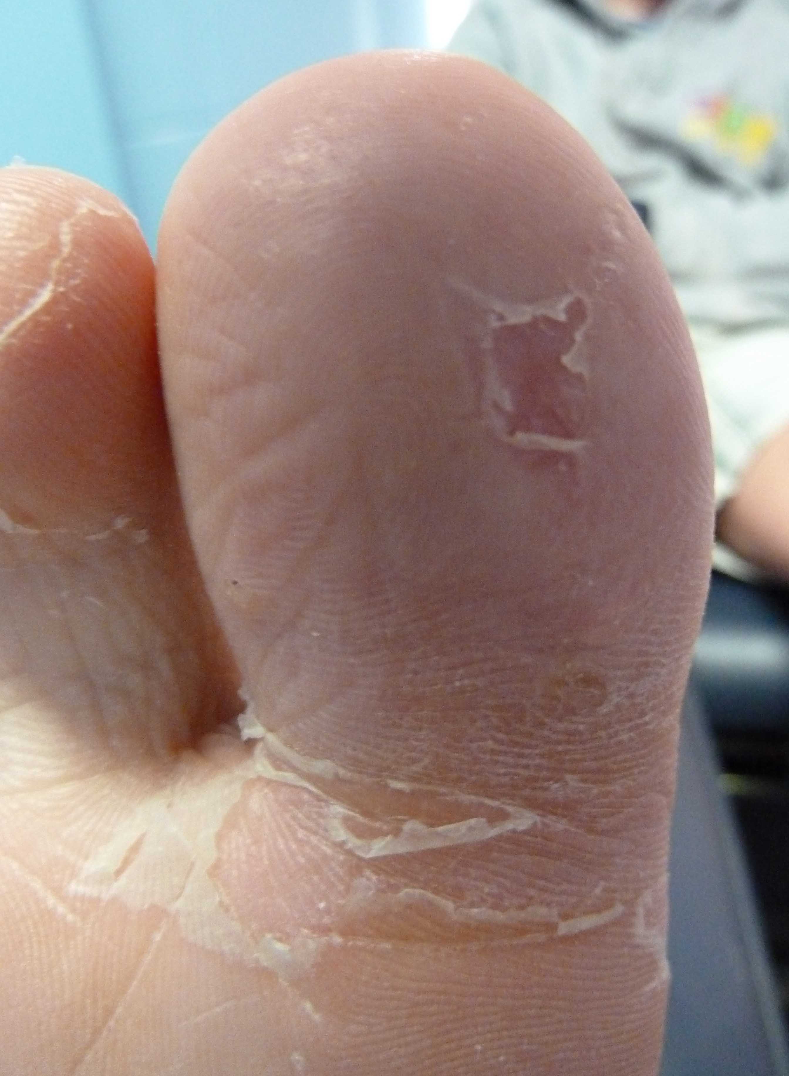 Warts and Plantar Warts -Topic Overview - WebMD