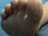 plantar-wart-4
