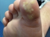 plantar-wart-5