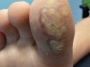 plantar-wart-6