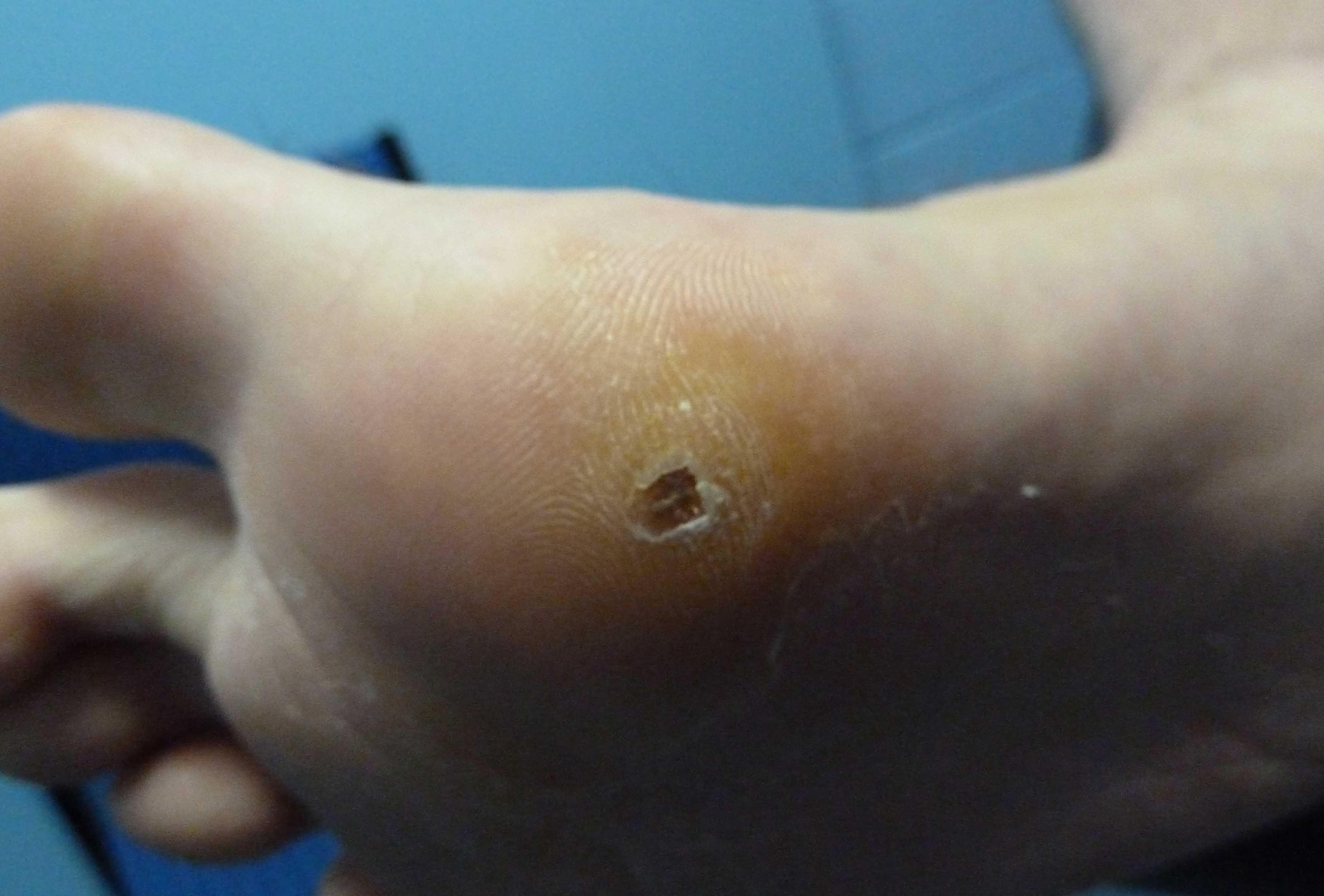 Plantar Warts | brightonpodiatry.com.au