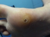plantar-wart-10