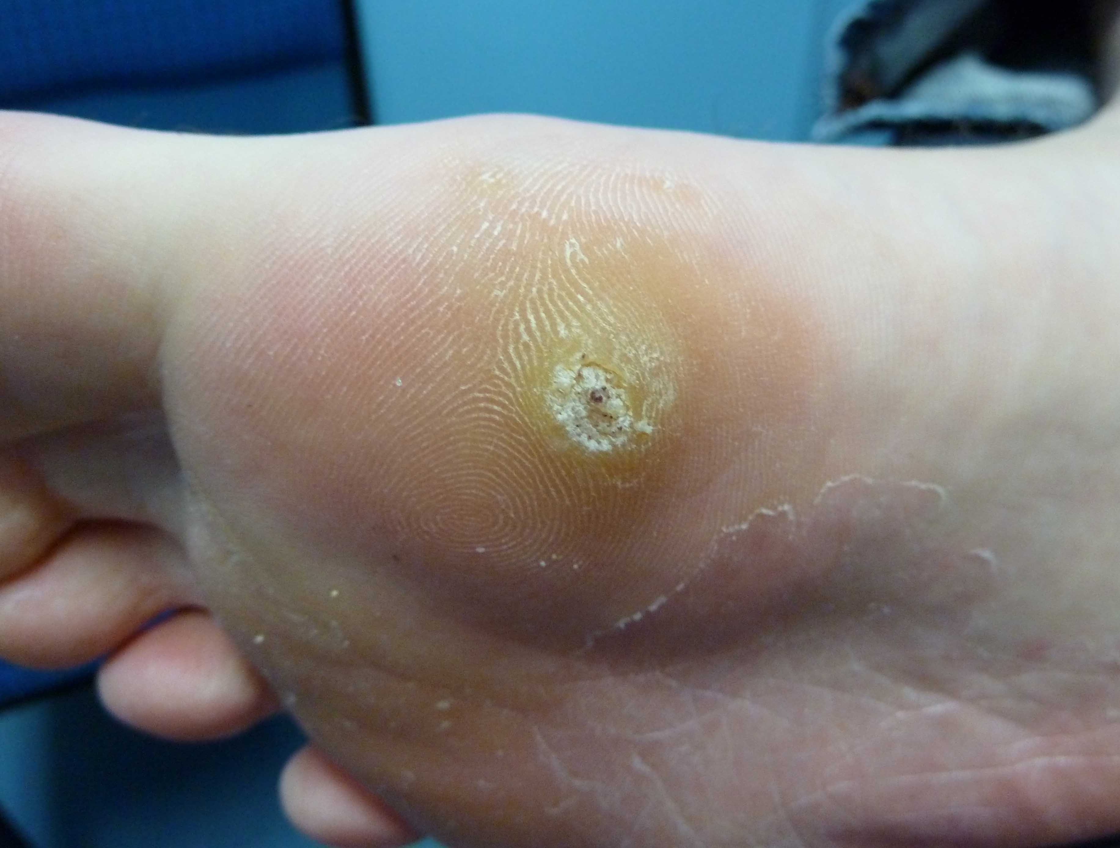 Plantar warts - Mayo Clinic