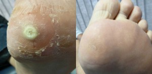 Plantar Wart Treatment Before and After