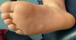 Foot Wart