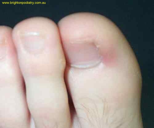 Ingrown nail