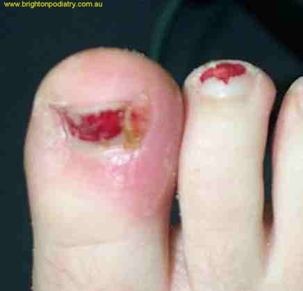 Ingrown toenail 2