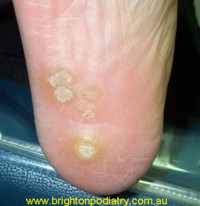 warts