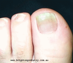 fungal nail