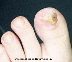 Fungal toenail