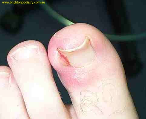 Ingrown toenail 1