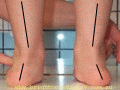 pronation rearfoot