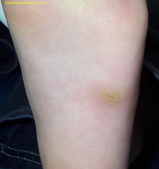 warts foot