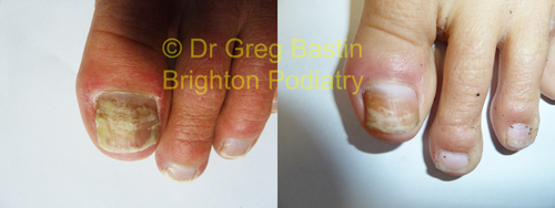 Nail Fungus Result 1