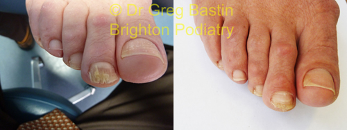 Nail Fungus Result 9