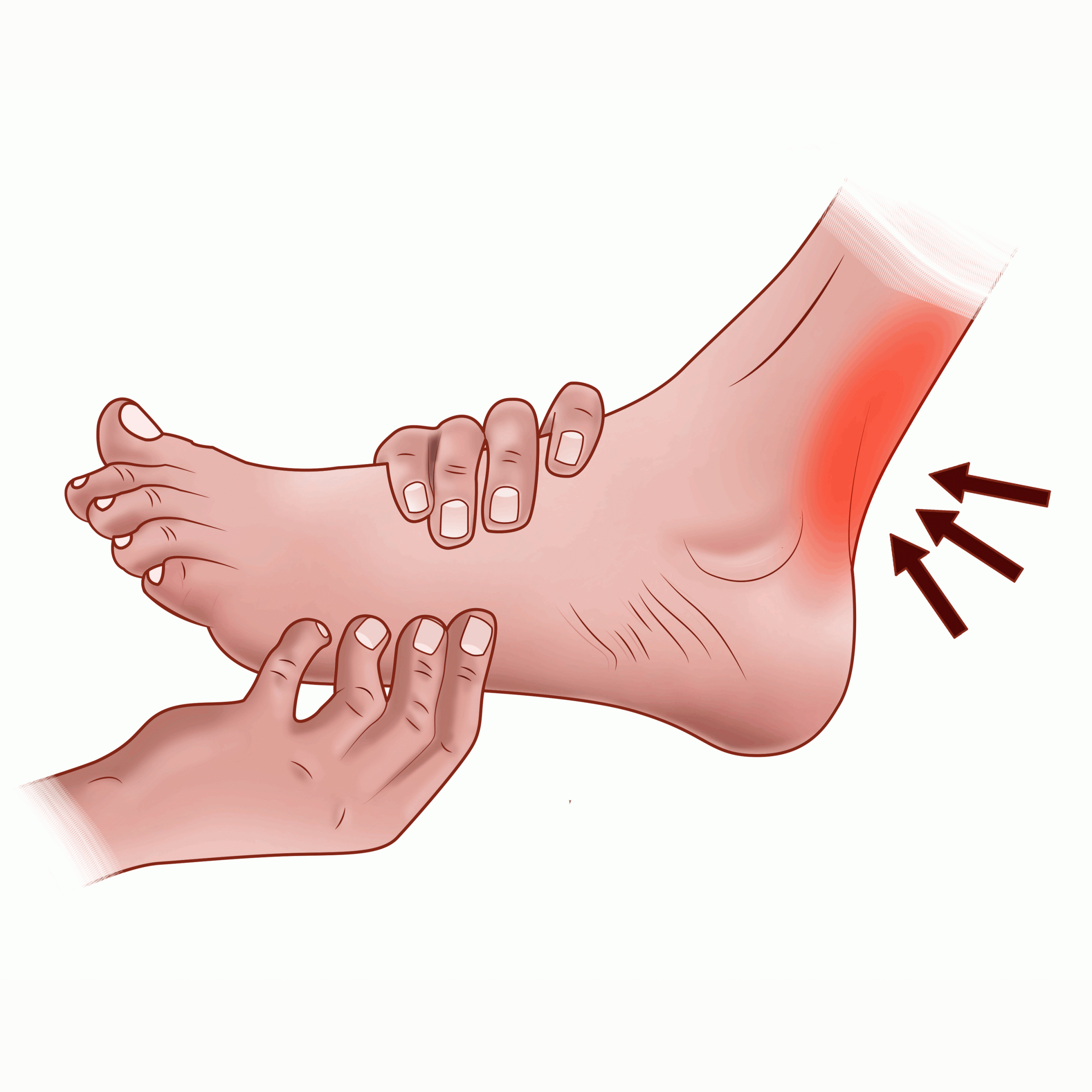 Plantar Warts