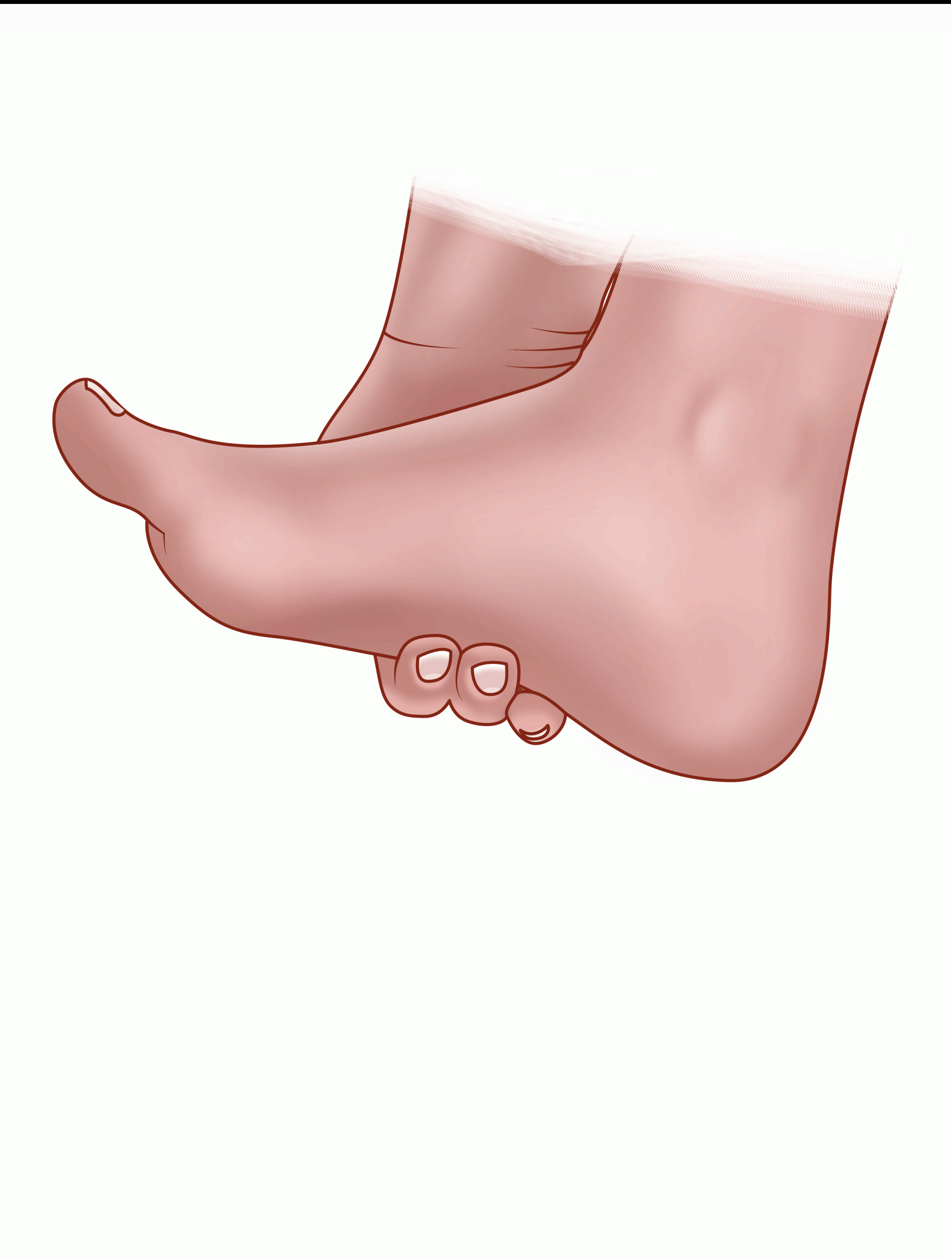 Plantar Warts