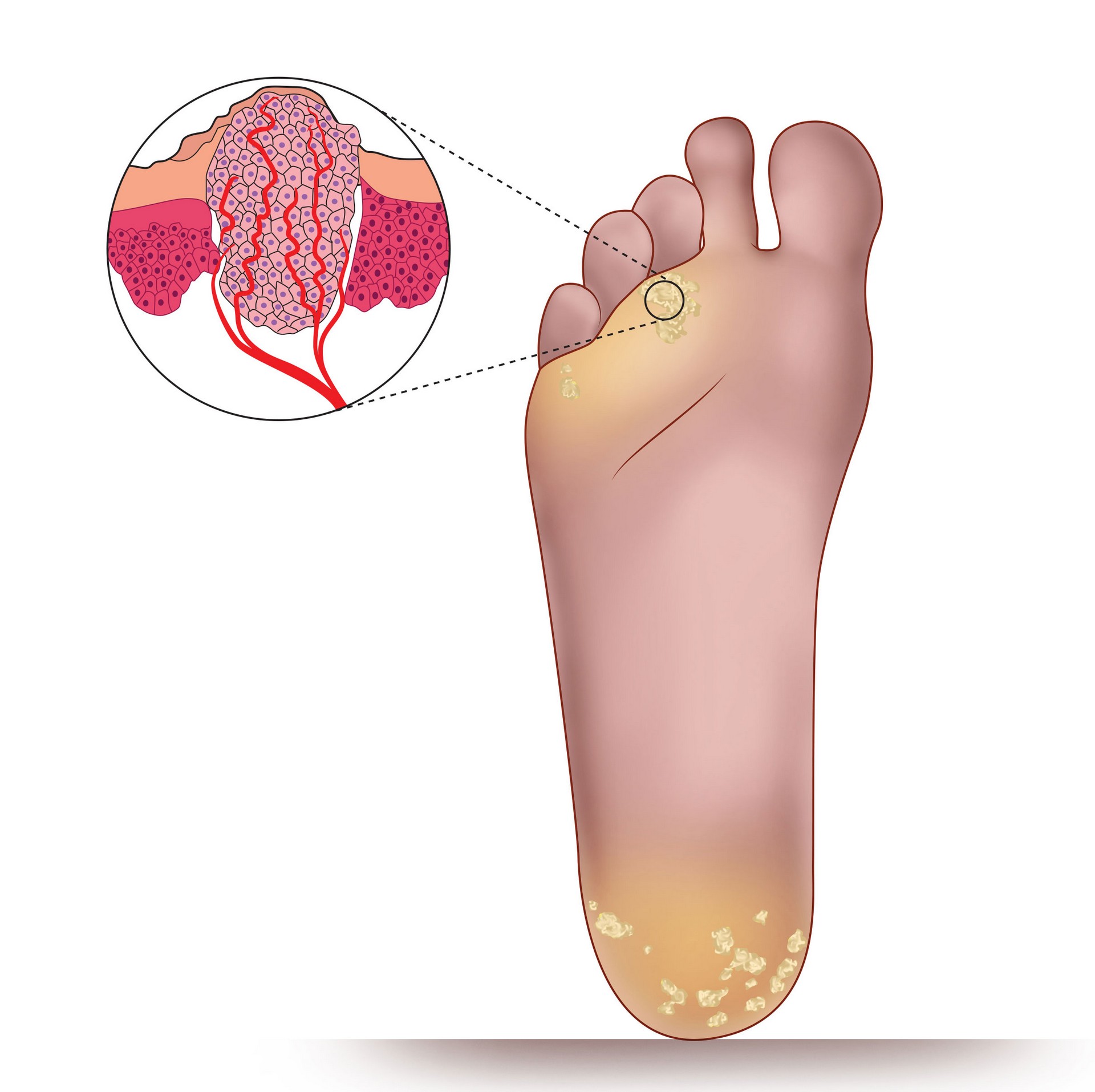 Plantar Warts