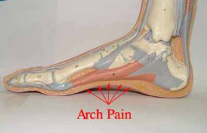 Arch Pain Plantar Fascia