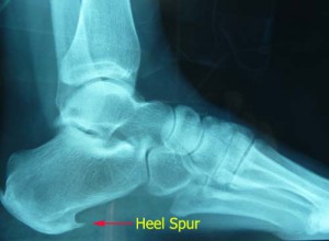 Heel Spur