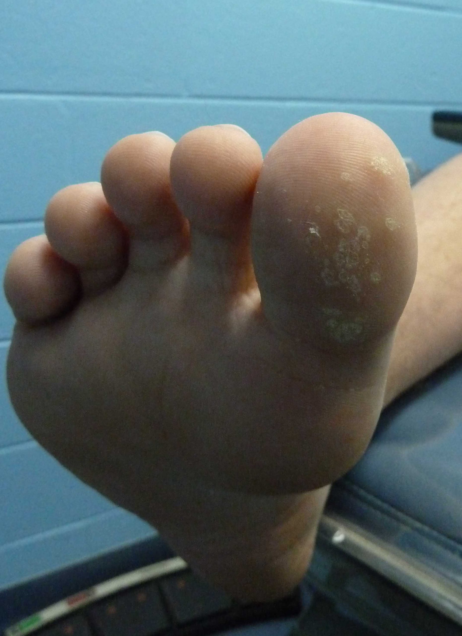 Plantar Wart 4