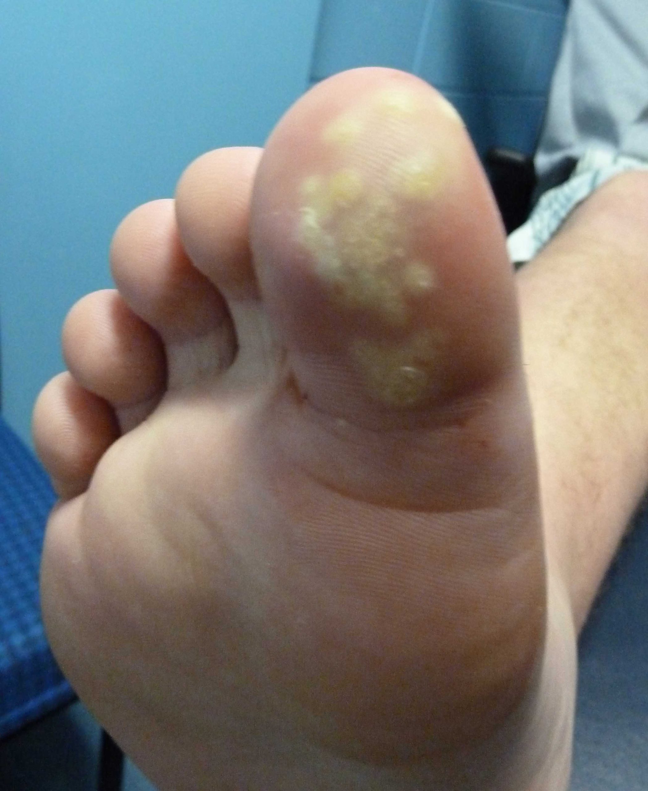 Plantar Wart 5