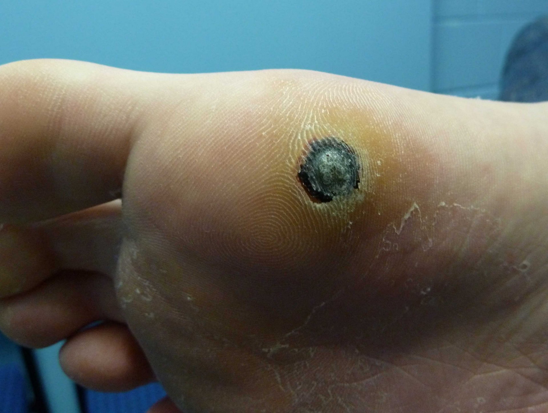 Plantar Wart 9